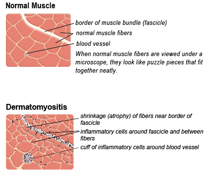 In dermatomyositis, inflammatory cells are concentrated around blood vessels at the borders of the muscle fiber bundles (fascicles), and fibers in this region often shrink. Inflammatory cells can sometimes be seen forming a cuff around blood vessels.