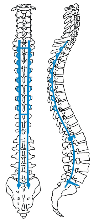 Scoliosis surgery involves using rods and screws to straighten and stabilize the spine.