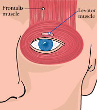 The purpose of a frontalis sling operation is to allow the frontalis muscle, which normally maintains its strength in OPMD, to open the eye.