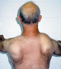 This man also shows a typical nonsymmetrical pattern of weakness, with scapular winging and slight scoliosis.
