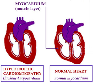 FA may lead to enlargement of the myocardium, the muscle layer of the heart.