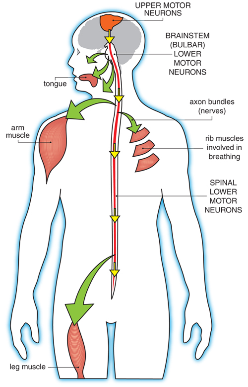 Amyotrophic Lateral Sclerosis Lou Gehrig Disease Motor Neuron Disease 