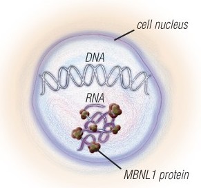 The nerve and muscle cells of people with MMD1 and MMD2 have expanded sections of DNA, which are converted to expanded sections of RNA. The RNA traps a protein called MBNL1 and has other toxic effects on the cells. Several experimental therapies that target the expanded RNA are in the pipeline.