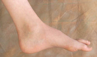 Foot contractures resulting in high-arched feet often occur in CMT.