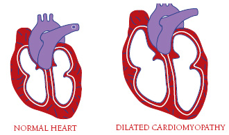 Illustration of a heart with dilated cardiomyopathy