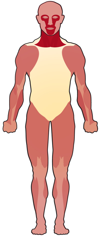 Overview Myasthenia Gravis Mda 9380