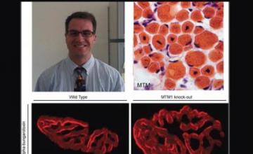 James Dowling (MTM): Pictured (top left) Dowling in his office; (top right) a muscle biopsy sample taken from a person with MTM — the large central nuclei are the defining biological features of the disease. Both bottom photos depict muscle stained with alpha bungarotoxin, a marker for the neuromuscular junction. On the left is muscle from a mouse unaffected by MTM. To the right is muscle from an MTM-affected mouse, in which the junctions clearly are significantly larger.