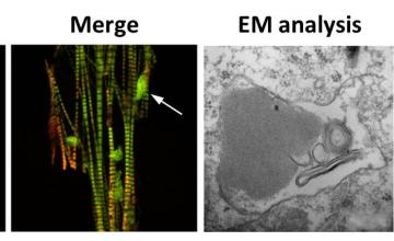 Mutation of the MYH7 gene causes myosin protein to accumulate in the cytoplasm, as shown here (arrow). The structure of the aggregates resolved by electron microscopy analysis also is shown.