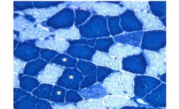Vihang Narkar (DMD/BMD): Aerobic muscle (dark blue) is resistant to fatigue and damage. Narkar's research team is investigating biological pathways that can be therapeutically targeted to increase this muscle type as a strategy for ameliorating some symptoms of Duchenne muscular dystrophy.
