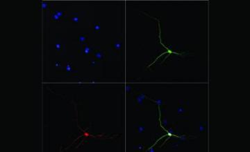 Claudio Sette (SMA): Pictured neural (nervous system) stem cells grown in conditions that encourage them to mature into motor neurons. The cells, once isolated and grown, were analyzed for neuronal markers (green) and photographed using a confocal microscope. The blue staining (upper left) shows cell nuclei; the green staining marks neurons; and the red staining shows that the neuron has migratory potential. Bottom right: A merged image of the three other panels indicates the strong potential of neural ste