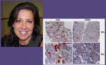 Melissa Spencer (DMD/BMD): Pictured is a section (left) of a diaphragm muscle taken from a dystrophin-deficient mouse (top, lower magnification; bottom, higher magnification). Immune system cells are stained red. On the right is a section of a diaphragm muscle taken from a dystrophin-deficient, osteopontin-deficient mouse. There are almost no immune system cells in this sample.