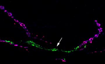 A fruit fly neuromuscular junction showing synaptic terminals (purple) and mutant TDP43 protein forming puncta, or points, in glial cells (green) surrounding the motor neuron axon (not shown).