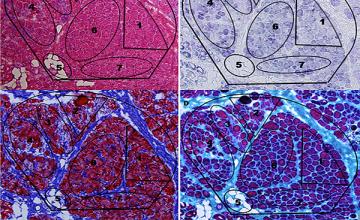 Shown is a section of muscle from a child with Duchenne muscular dystrophy, imaged in different ways. The data show a fingerprint suggestive of asynchronous regeneration in DMD muscle.