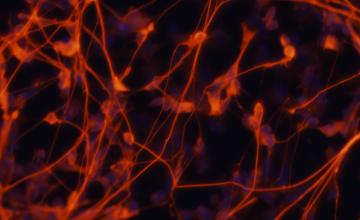 Neurons (nerve cells) containing the Friedreich’s ataxia mutation are shown in this microscope image.