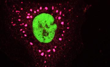 Christine Vande Velde (ALS): Cell showing stress granules; TDP43 is green; stress granule markers G3BP are red; TIA-1 is blue; overlap of all three is purple.