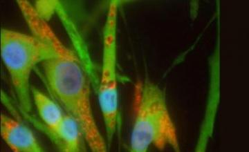 Virginia Kimonis (IBM): Myoblasts (immature muscle cells) taken from people with inclusion-body myopathy associated with Paget's disease of Bone and/or frontotemporal dementia show accumulation of valosin-containing protein, or VCP (green). The VCP that is produced has mutations (flaws), and preliminary studies have shown that the mutations make the protein overactive, so too much is not a good thing. Cell nuclei are stained blue.