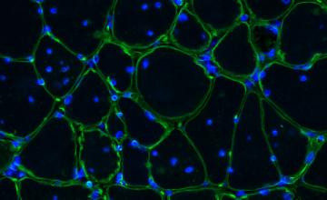 Thurman Wheeler (MMD): A fluorescence microscope image showing advanced muscle disease in a mouse model of myotonic dystrophy. Muscle fibers are outlined in green and muscle nuclei are highlighted in blue.